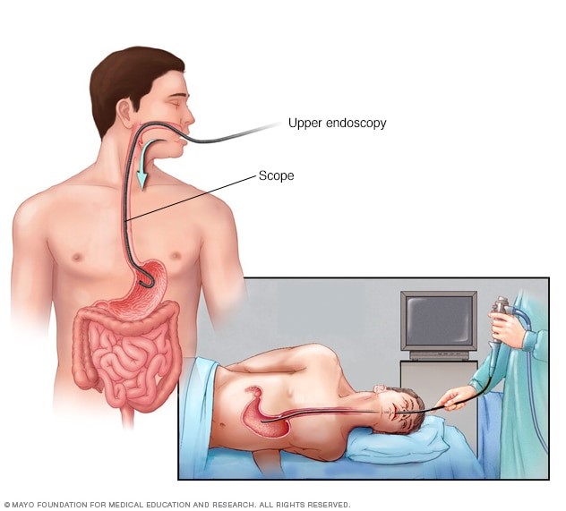 Gastroscopy and colonoscopy: key procedures to early detect gastric cancer