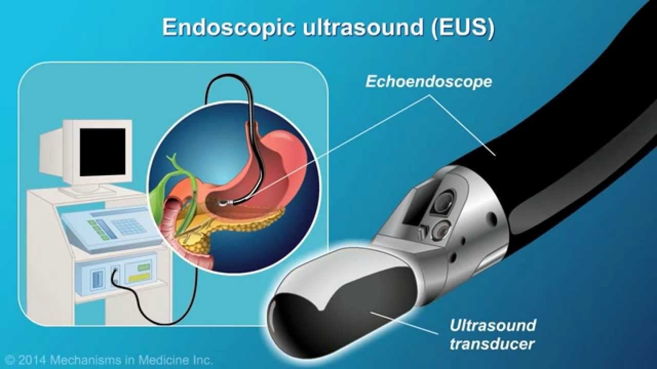 Role of Endoscopy in The Early Detection of Stomach Cancer